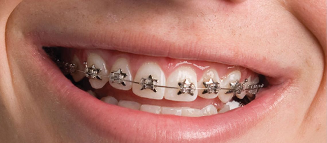 通過箍牙治療改善您的笑容